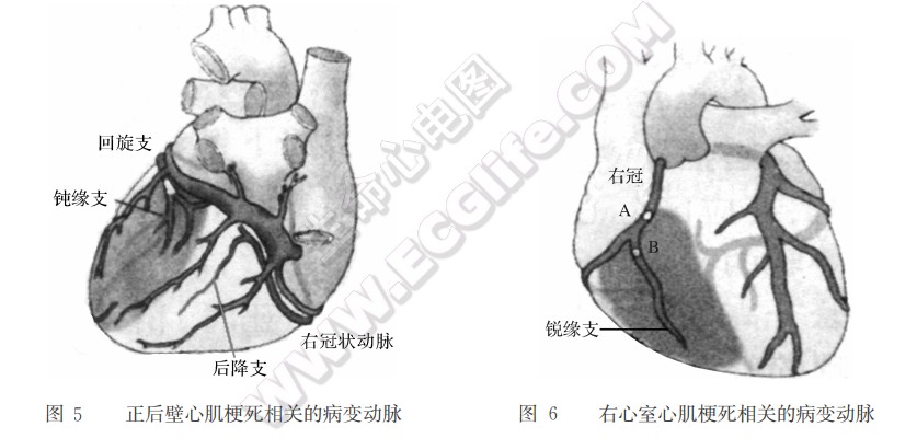 正后壁心肌梗死相关的病变动脉、右心室心肌梗死相关的病变动脉