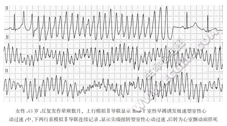 短偶联间期尖端扭转型室性心动过速综合征心电图