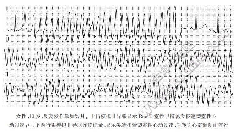 短偶联间期尖端扭转型室性心动过速综合征