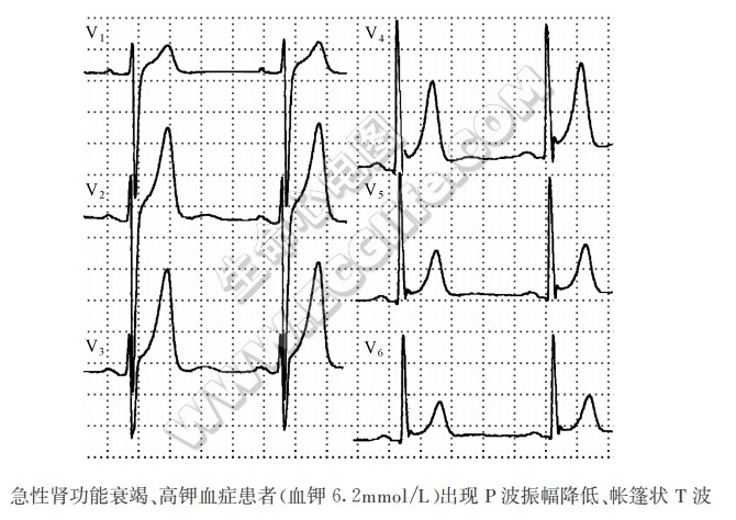 急性肾功能衰竭、高钾血症患者心电图