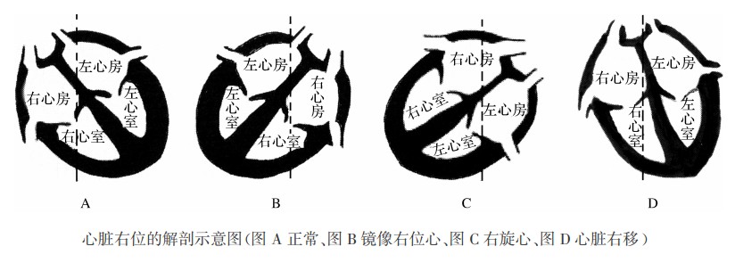 右位心（镜像右位心、右旋心）的心电图表现