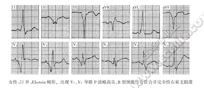 女性，51岁，三尖瓣下移畸形。出现V1、V2导联P波略高尖、B型预激综合征合并完全性右柬支阻滞心电图