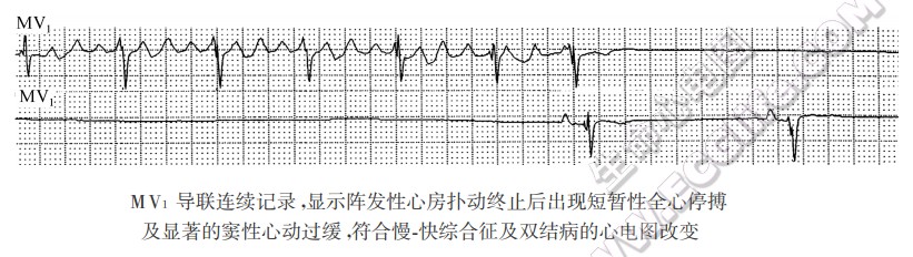 超速抑制现象