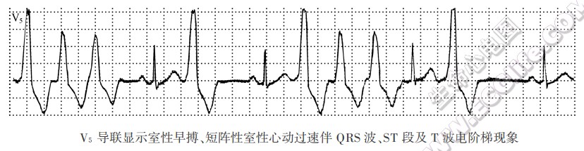 V5导联显示室性早搏、短阵性室性心动过速伴QRS波、ST段及T波电阶梯现象
