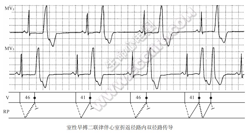 室性早搏二联律伴心室折返径路内双径路传导