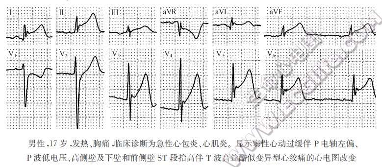急性心包炎心电图