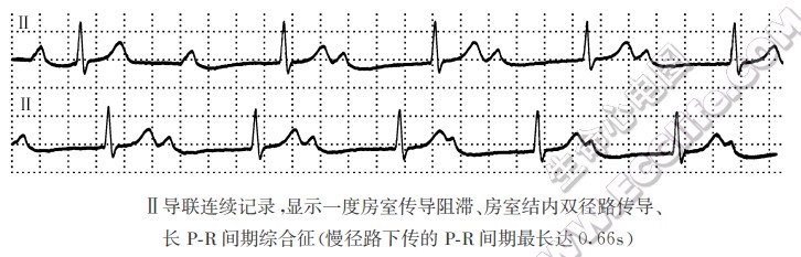 长PR间期综合征心电图