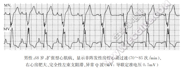 扩张型心肌病2