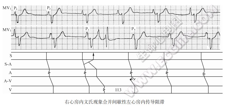 有心房内文氏现象合并间歇性左心房内传导阻滞心电图精解