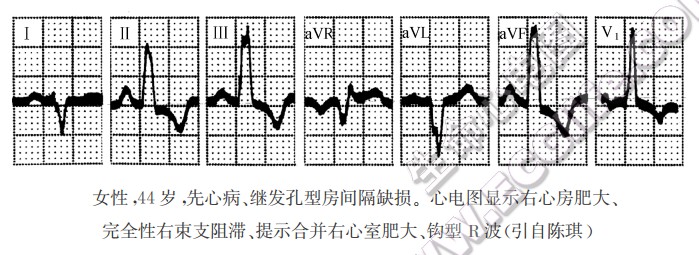 房间隔缺损病理生理改变及心电图特征