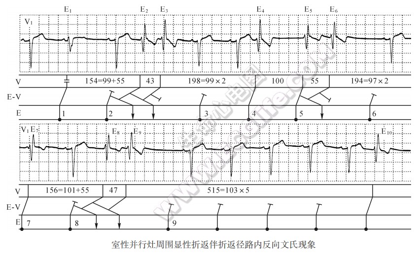 室性并行灶周围显性折返伴折返径路内反向文氏现象