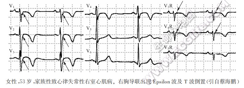 右室心肌病心电图1