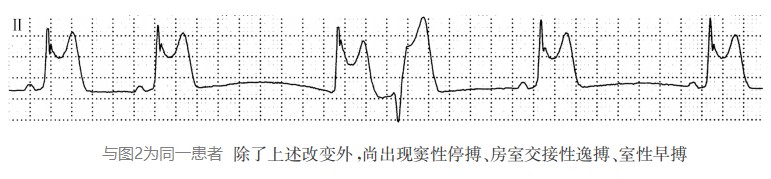 出现窦性停搏、房室交接性逸搏、室性早搏