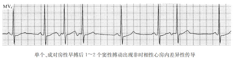 单个、成对房性早搏后1-2个窦性搏动出现非时相性心房内差异性传导心电图