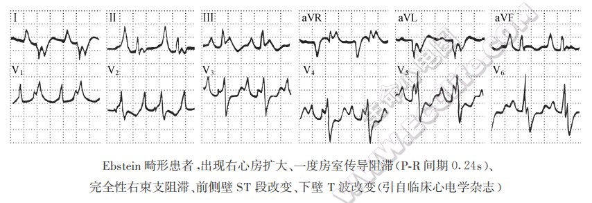 三尖瓣下移畸形，出现右心房扩大、一度房室传导阻滞（PR间期0.24s）、完全性右柬支阻滞、前侧壁ST段改变、下壁T波改变（引自临床心电学杂志）