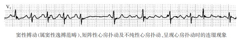 窦性搏动（属窦性逸搏范畴）、短阵性心房扑动及不纯性心房扑动、呈现心房扑动时的连缀现象心电图