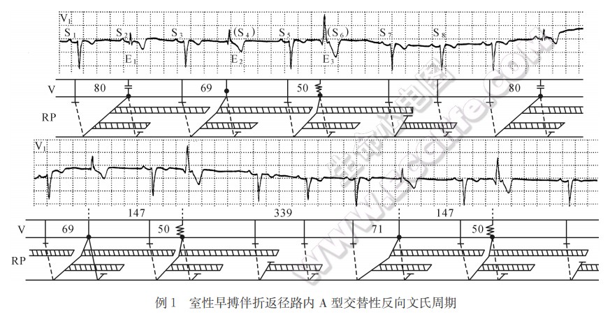 室性早搏伴折返径路内A型交替性反向文氏周期心电图精解