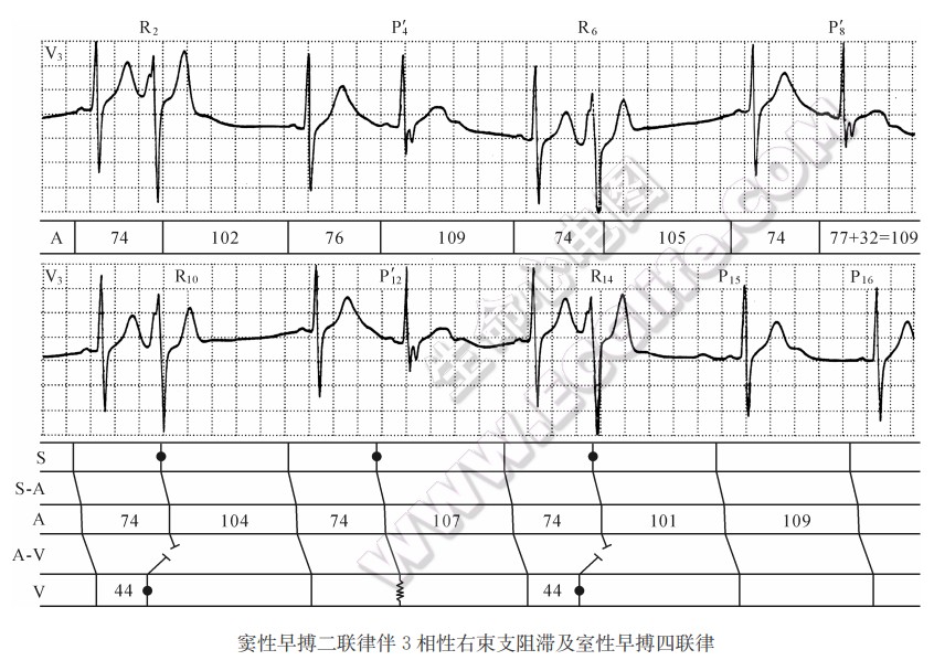 窦性早搏二联律伴3相性右束支阻滞及室性早搏四联律心电图精解