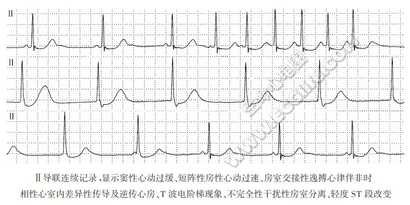 Ⅱ导联连续记录，显示窦性心动过缓、短阵性房性心动过速、房室交接性逸搏心律伴非时相性心室内差异性传导及逆传心房、T波电阶梯现象、不完全性干扰性房室分离、轻度ST段改变