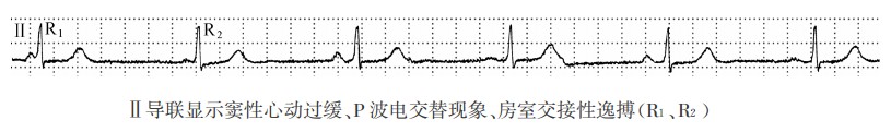 P波电交替现象的心电图特征、发生机制、临床意义