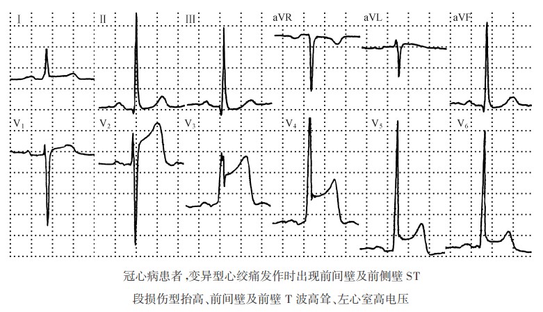   冠心病患者，，变异型心绞痛发作时出现前间壁及前侧壁ST段损伤型抬高、前间壁及前壁T波高耸、左心室高电压心电图
