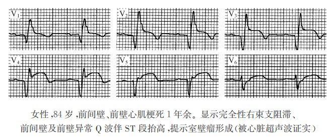 再灌注治疗对急性心肌梗死转归的影响