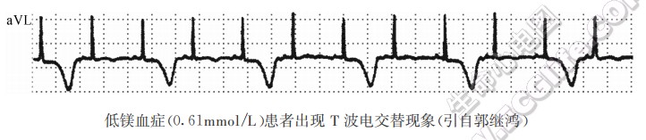 低镁血症心电图表现