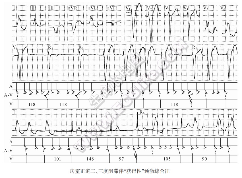 房室正道二、三度阻滞伴“获得性”预激综合征心电图精解