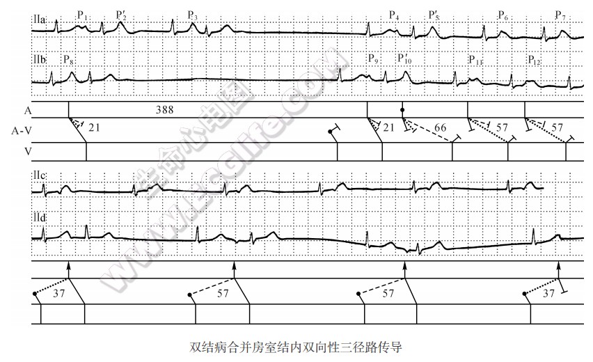 双结病合并房室结内双向性三径路传导心电图精解