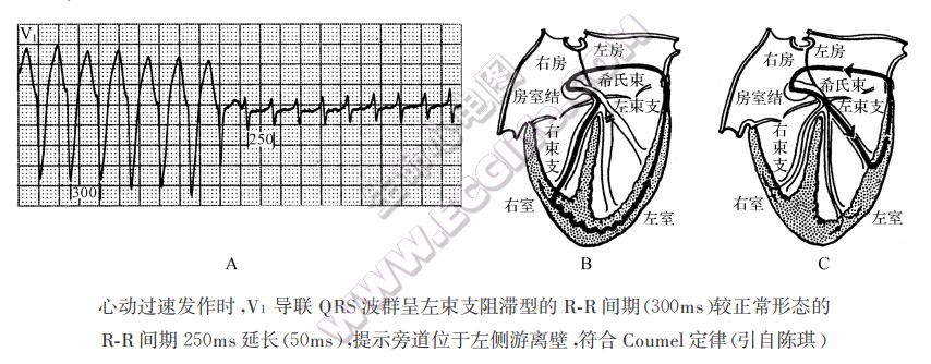 Coumel现象（Coumel定律）的心电图表现及临床意义