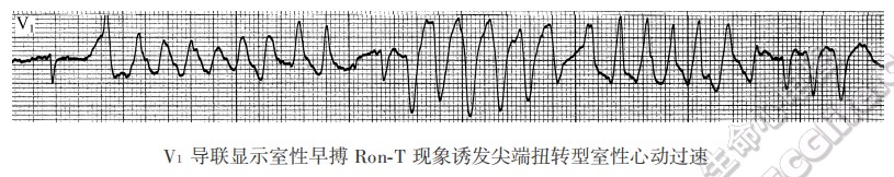 V1导联显示室性早搏Ron-T现象诱发尖端扭转型室性。心动过速-心电图