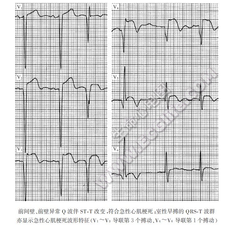 从室性异位搏动图形中诊断心肌梗死心电图