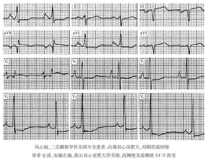风湿性心脏病病理及心电图表现