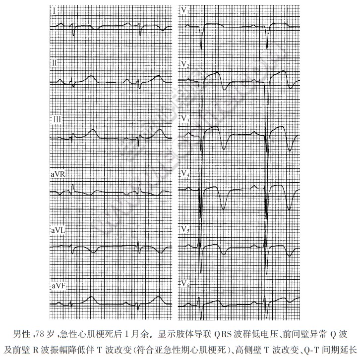 亚急性期（演变期）心肌梗死心电图