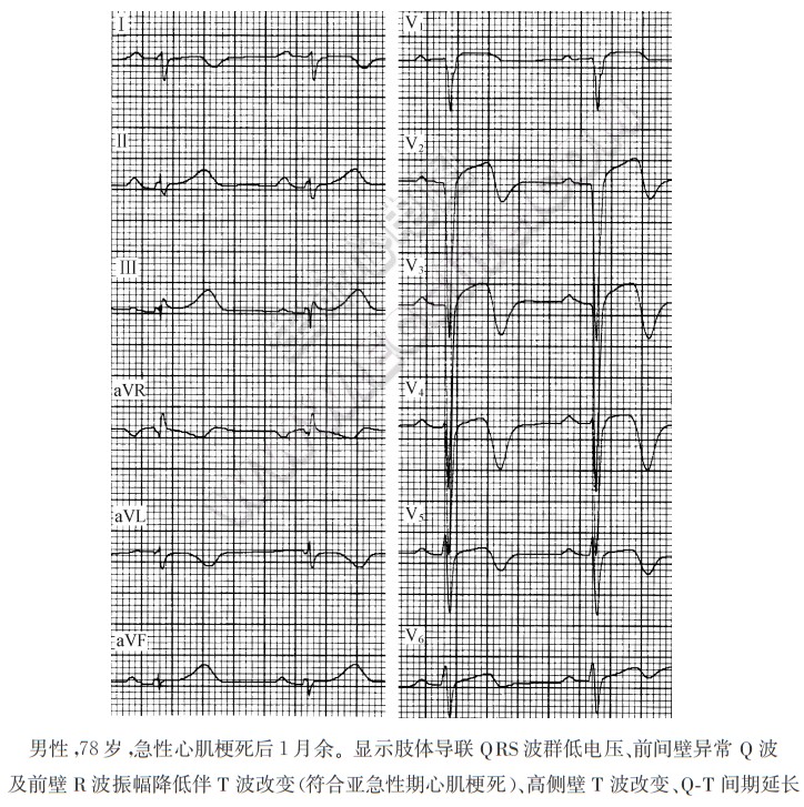 心电图胸导联低电压图片