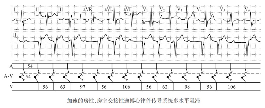 加速的房性、房室交接性逸搏心律伴传导系统多水平阻滞心电图精解