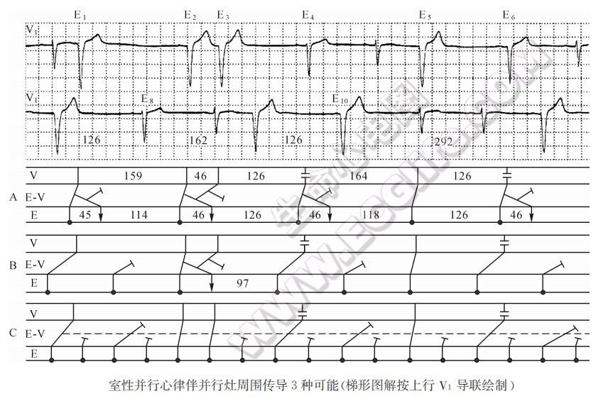 室性并行心律伴并行灶周围传导3种可能