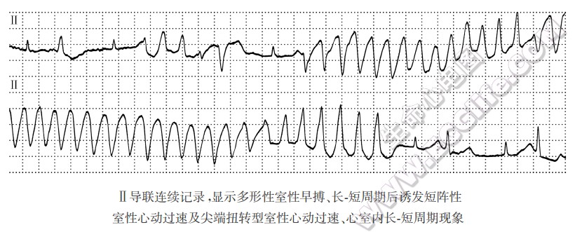 Ⅱ导联连续记录，显示多形性室性早搏、长短周期后诱发短阵性室性心动过速及尖端扭转型室性心动过速、心室内长短周期现象心电图