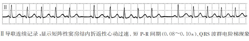 QRS-T波群电阶梯现象