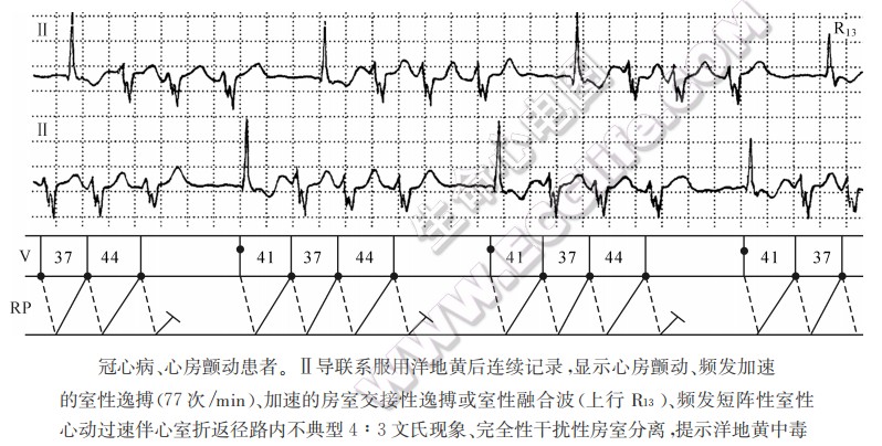 洋地黄对心脏的作用、中毒诊断及心电图表现