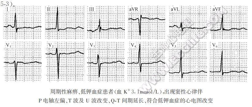 周期性麻痹、低钾血症患者心电图