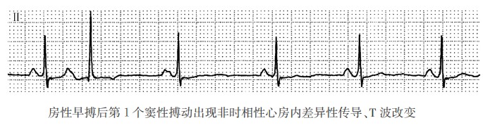 房性早搏后第1个窦性搏动出现非时相性心房内差异性传导、T波改变