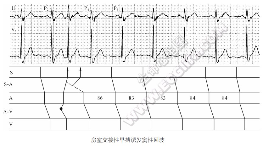 房室交接性早搏诱发窦性回波心电图精解