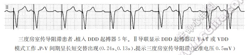 出现PV间期长、短交替（心电图）