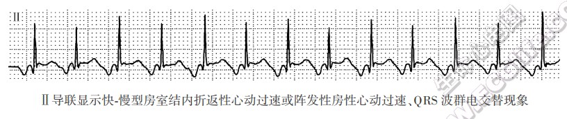 QRS波群电交替现象（心电图）
