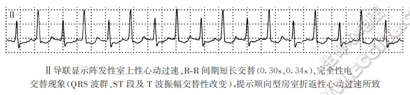 完全性电交替现象（心电图）