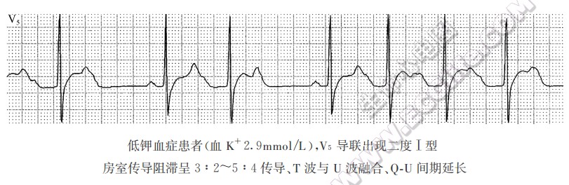 低钾血症患者心电图