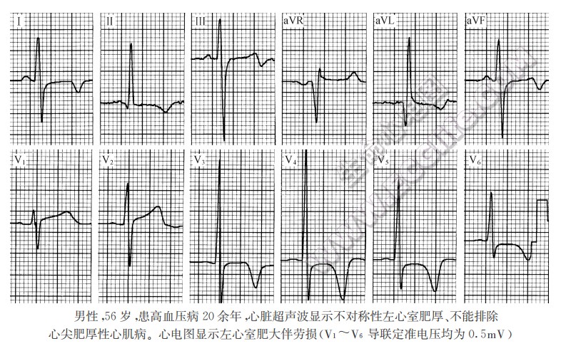 高血压性心脏病、心肌病病理及心电图表现