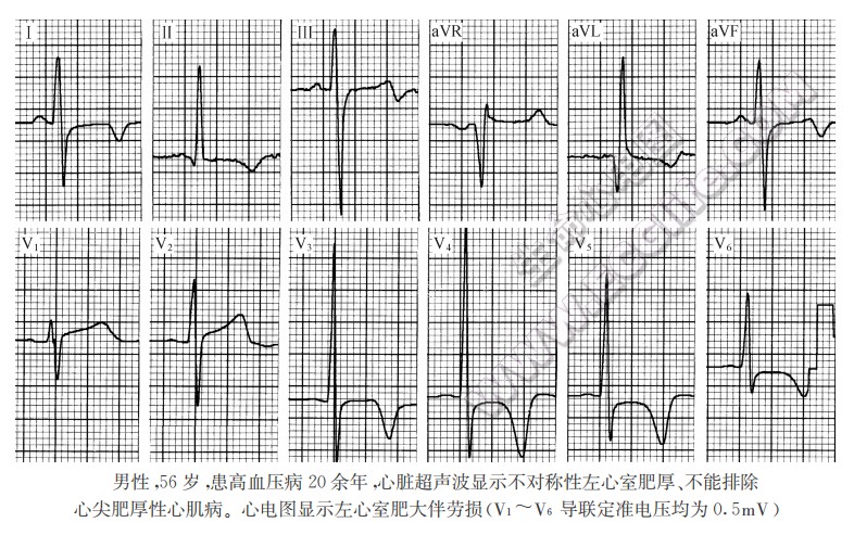 高血压性心脏病心电图