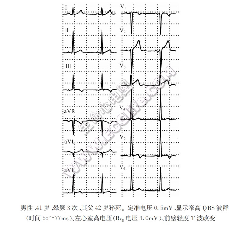 窄高QRS波综合征心电图